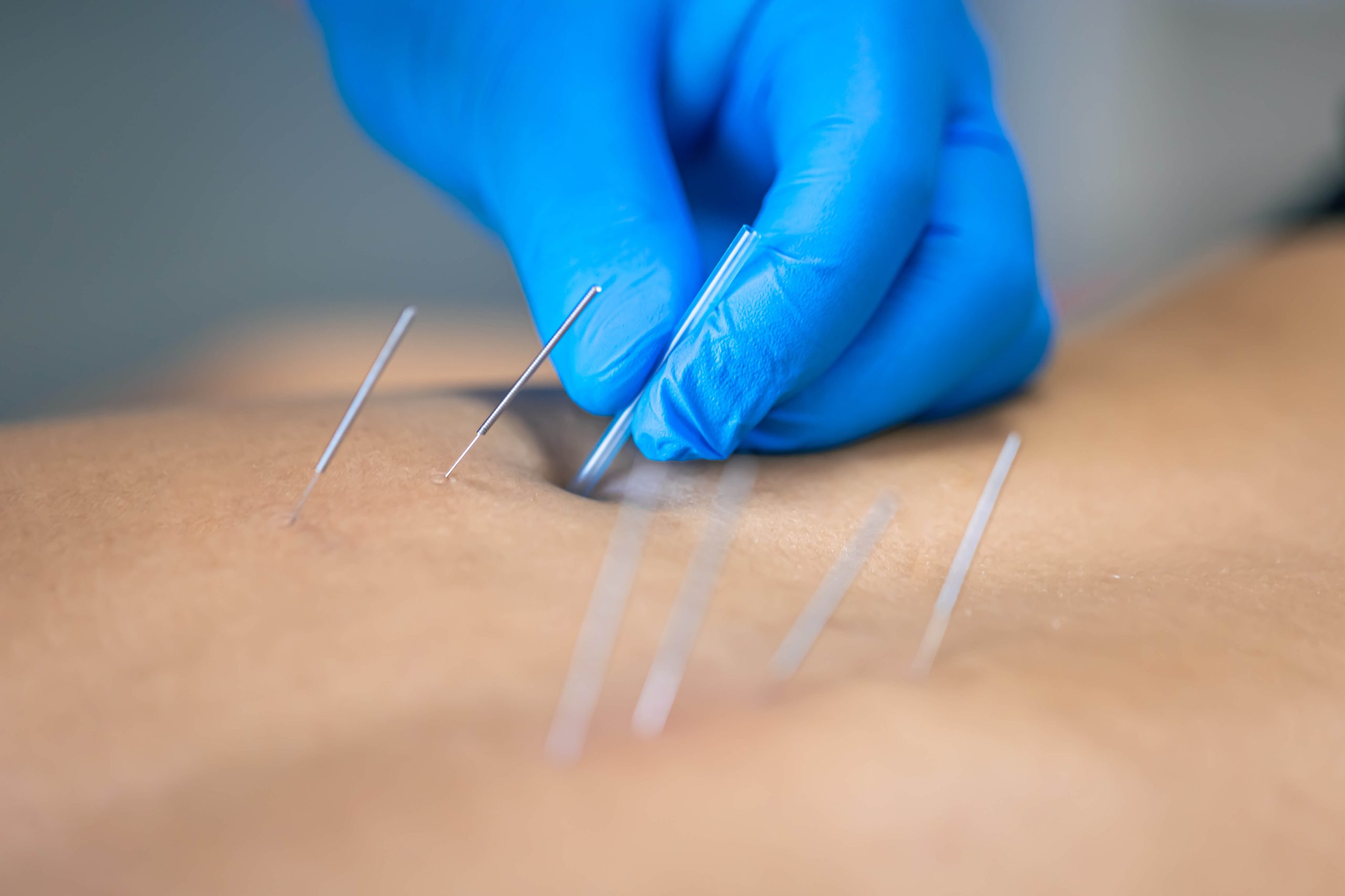 Dry needling Rijswijk